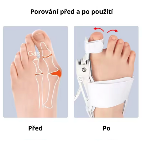 Ortopedická pomůcka na hallux valgus – DVOJBALENÍ